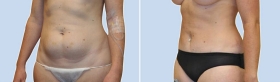Mini Tummy Tuck