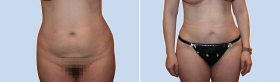 Mini Tummy Tuck