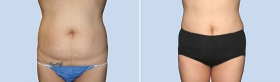 Mini Tummy Tuck