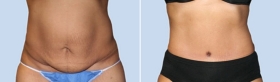 ABDOMINOPLASTY