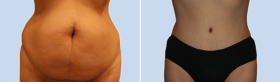 ABDOMINOPLASTY