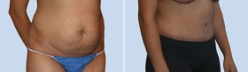 ABDOMINOPLASTY