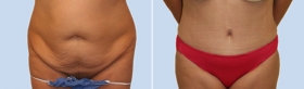ABDOMINOPLASTY