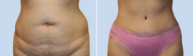 ABDOMINOPLASTY